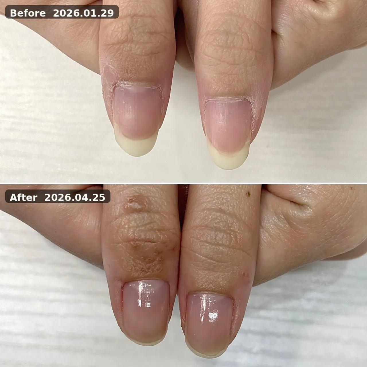 ビフォーアフター（親指） 2026.01.29→2026.04.25