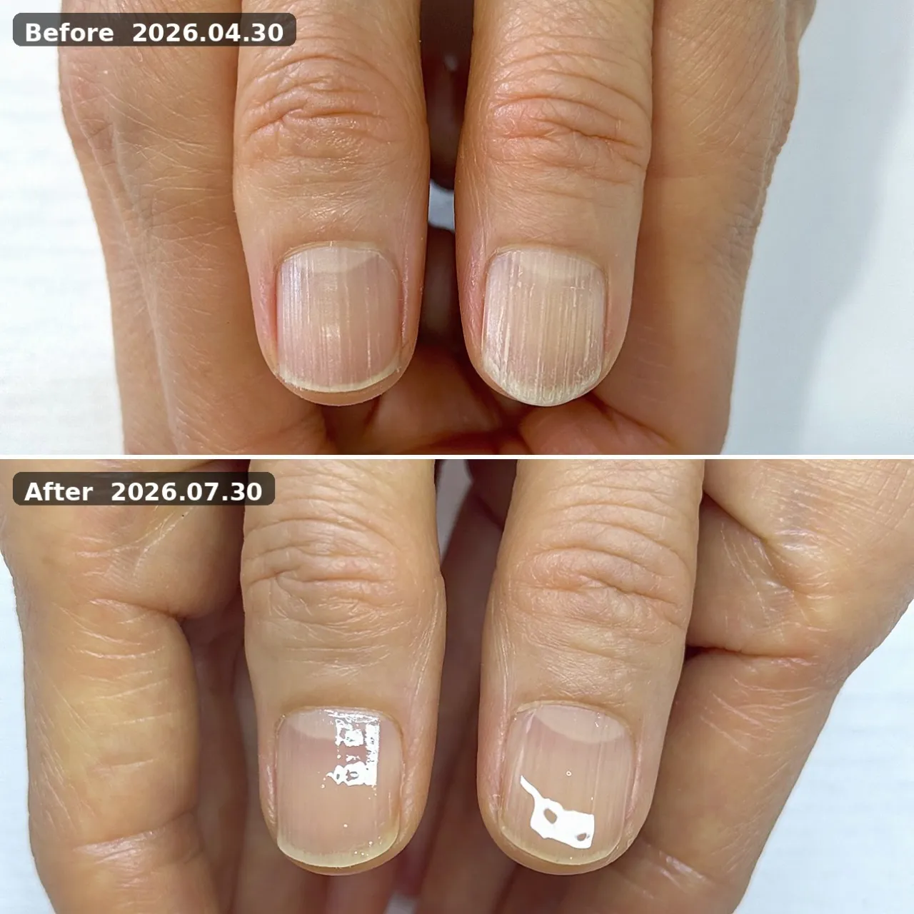 ビフォーアフター（親指） 2026.04.30→2026.07.30