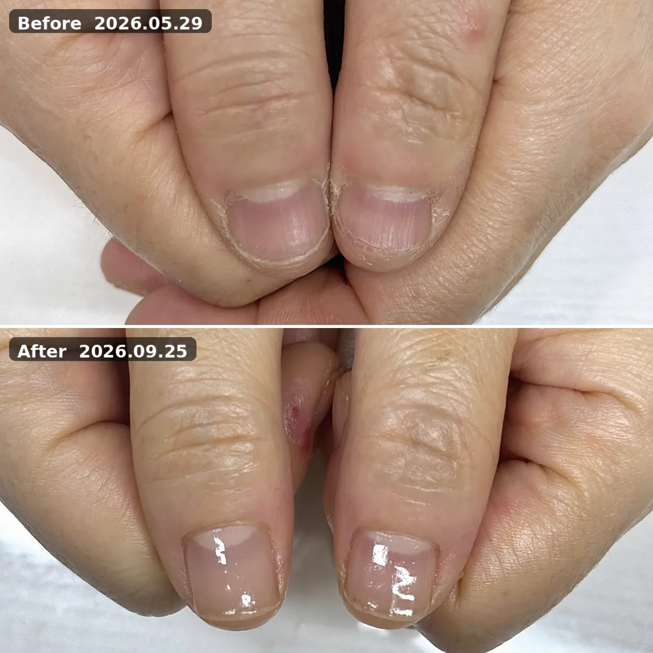 ビフォーアフター（親指） 2026.05.29→2026.09.25