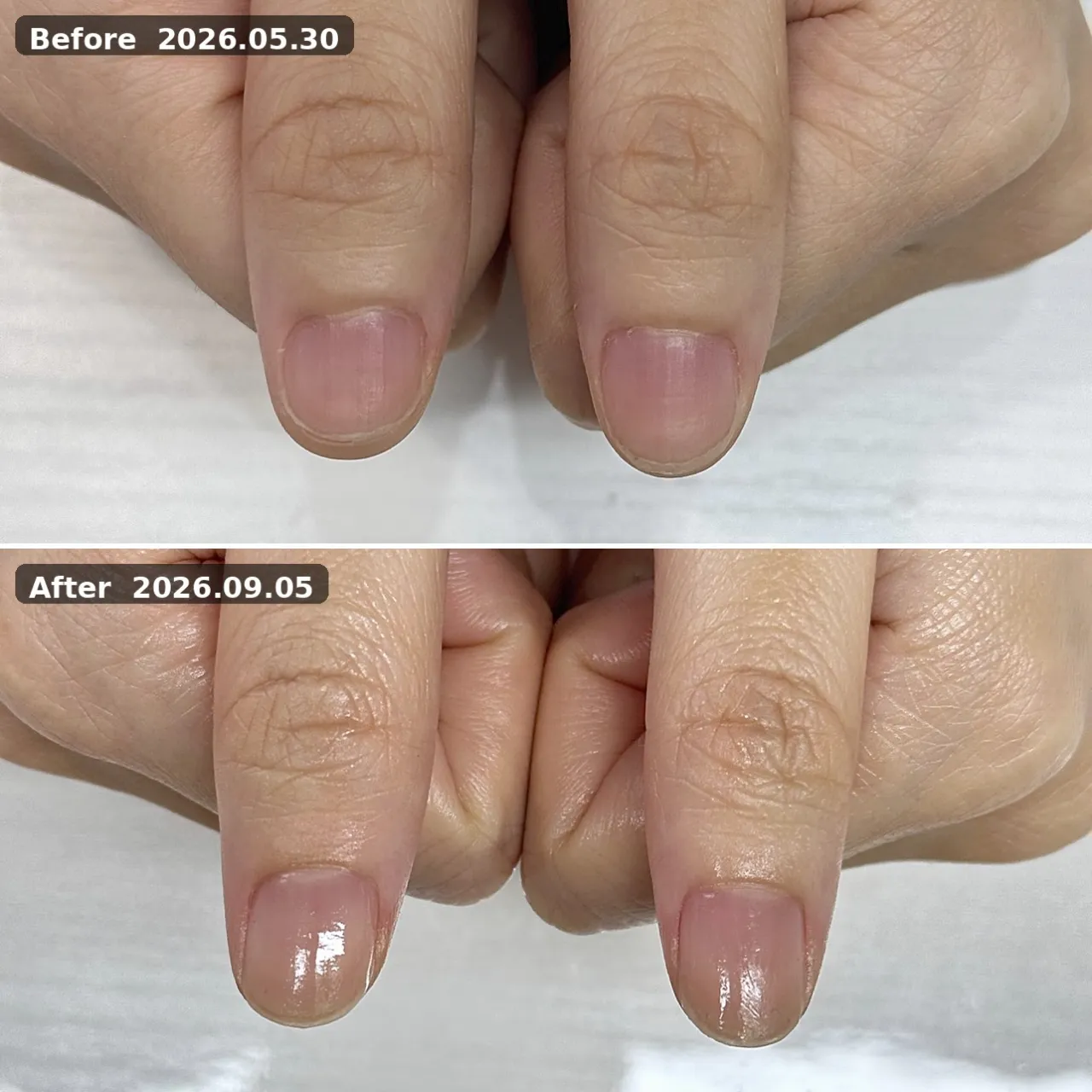 ビフォーアフター（親指） 2026.05.30→2026.09.05