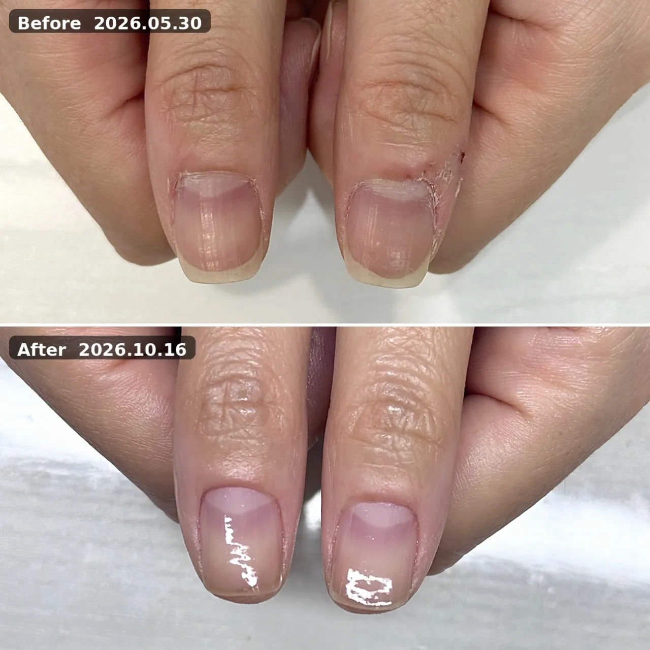 ビフォーアフター（親指） 2026.05.30→2026.10.16